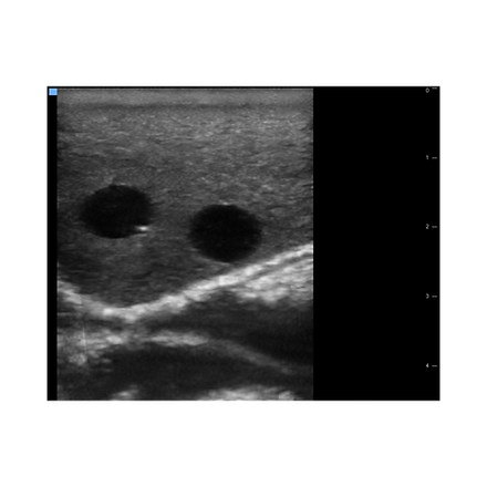 Femoral Block Simulator/Femoral, PENG, Fascia Iliaca, Femoral Triangle ...